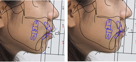 治療目標と横顔のシミュレーション（ゴールの可視可）